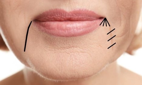 CYNEFILL Prestige Deep ZK MediGroup | CYNEFILL Prestige Deep