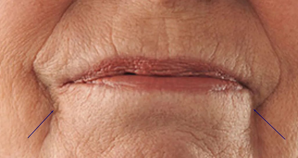 ZK MediGroup | How to Get Rid of Marionette Lines Without Surgery: A Review of CYNEFILL Filler