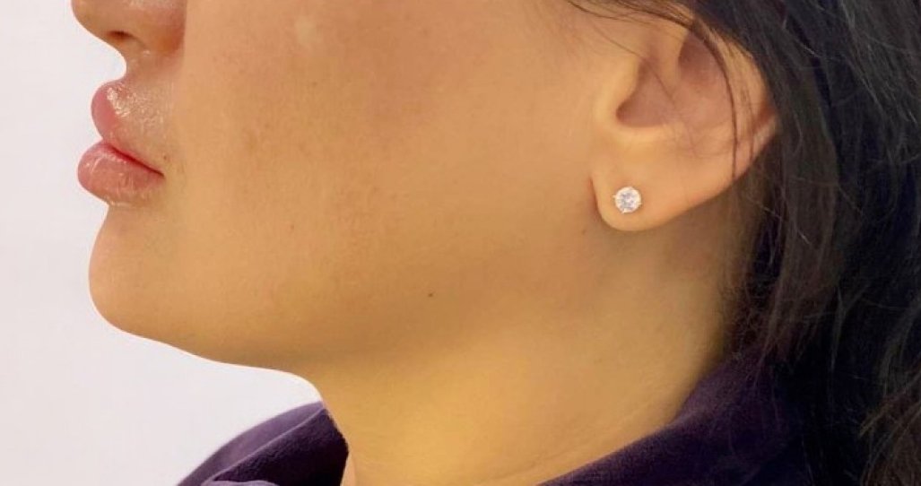 Lipolytic ZK MediGroup | Lipolytic