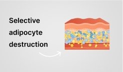 Injection process illustration