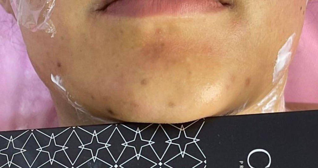 CYNEFILL Glamour Shape ZK MediGroup | CYNEFILL Glamour Shape