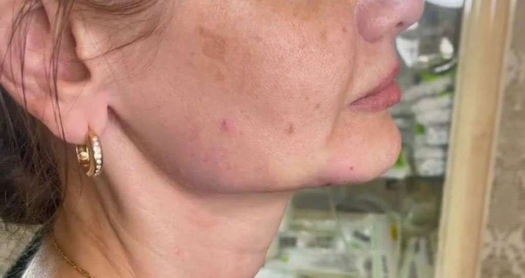 CYNEFILL Glamour Shape ZK MediGroup | CYNEFILL Glamour Shape