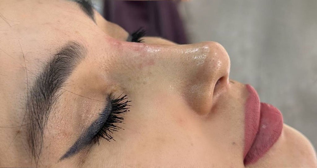 CYNEFILL Glamour Shape ZK MediGroup | CYNEFILL Glamour Shape