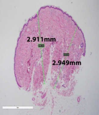 Skinbooster Dermis-Before