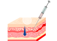 Skinbooster Epidermis