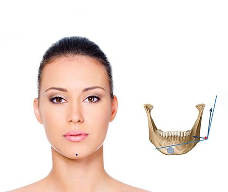 CYNEFILL Glamour Shape ZK MediGroup | CYNEFILL Glamour Shape