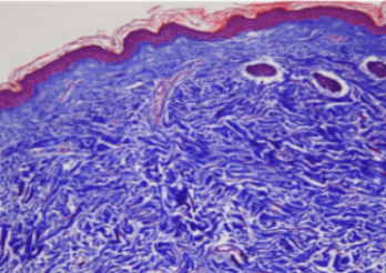 Skinbooster Skin derm visualization 1