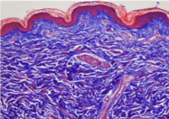 Skinbooster Skin derm visualization 2