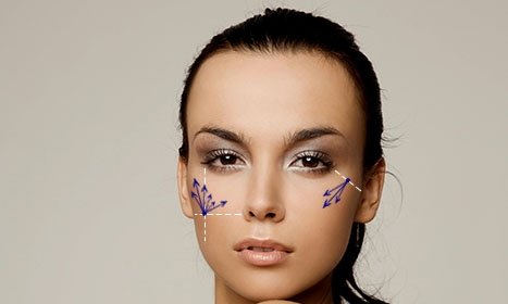 CYNEFILL STELLAR PLA ZK MediGroup | CYNEFILL STELLAR PLA