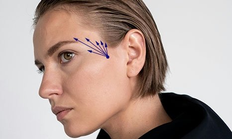 CYNEFILL STELLAR PLA ZK MediGroup | CYNEFILL STELLAR PLA