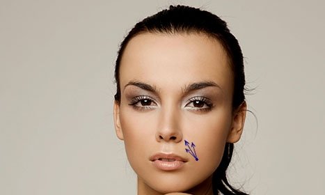 CYNEFILL STELLAR PLA ZK MediGroup | CYNEFILL STELLAR PLA