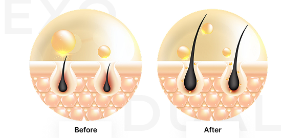 Exosome Skin Booster CYNEFILL ExoDual Visual representation of CYNEFILL EXODUAL benefits for hair loss treatment